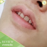 ทำปากกระจับ เชียงราย ที่ไหนดี - คลินิกศัลยกรรม เชียงราย Chic Clinic