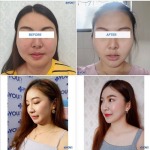  Botox, Thread Lift, Mesotherapy Filler, Chiang Rai Skin