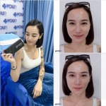  Botox, Thread Lift, Mesotherapy Filler, Chiang Rai Skin