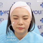 ฉีดฟิลเลอร์ใต้ตา เชียงราย - โบท็อก ร้อยไหม ฟิลเลอร์ เมโสแฟต ฉีดผิว เชียงราย