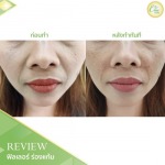ฟิลเลอร์ร่องแก้ม เชียงราย - คลินิกศัลยกรรม เชียงราย Chic Clinic