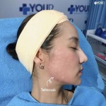 คลินิคเสริมความงาม เชียงราย - โบท็อก ร้อยไหม ฟิลเลอร์ เมโสแฟต ฉีดผิว เชียงราย