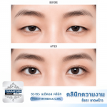 คลินิกแก้กล้ามเนื้อตาอ่อนแรง ตาล้า  ปรับหางตาตก l ลาดพร้าว กรุงเทพ
