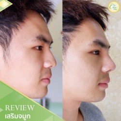 เสริมจมูก ผู้ชาย